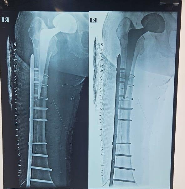Complex Polytrauma Management: Surgical Reconstruction of Shattered Bones & Pelvic Fractures