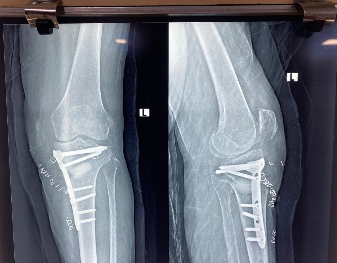Deformity Correction: Modern Surgical Techniques for Bowlegs (Genu Varum) & Knock Knees