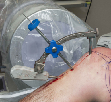 Complete Guide to ACL & PCL Ligament Tears: Diagnosis, Reconstruction & Safe Return to Sports