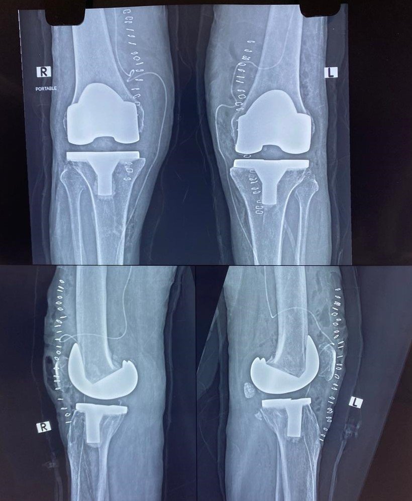 Total Knee Replacement (TKR): Recovery Milestones, Pain Management & Life After Surgery