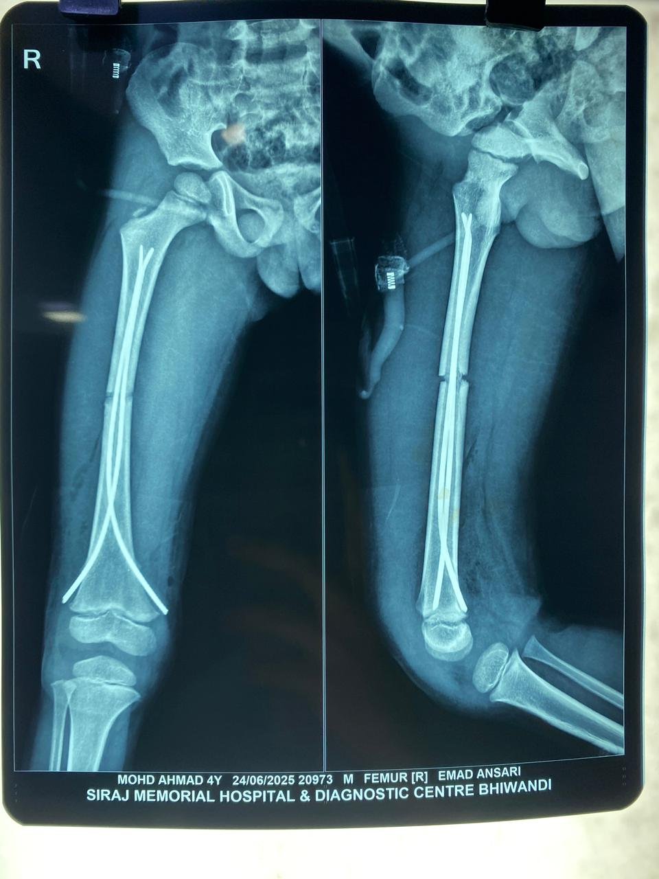 Paediatric Trauma