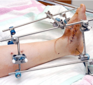 Deformity Correction Surgeries